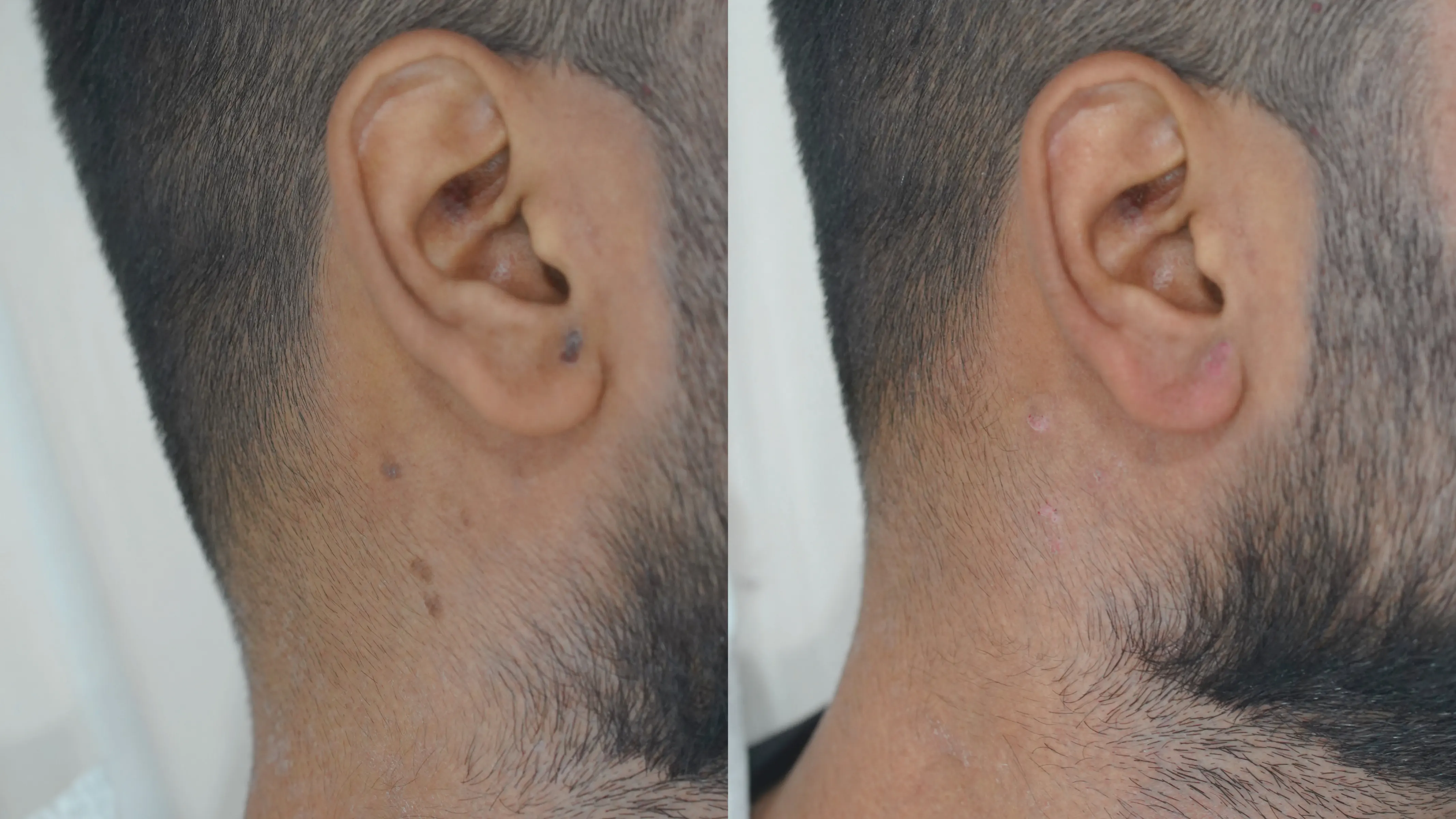 Skin Resurfacing Collage